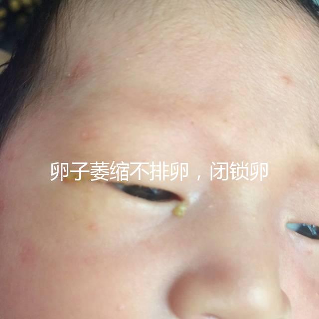 卵子萎縮不排卵，閉鎖卵泡形成原因與這4點有關