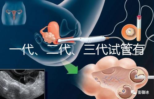 一代、二代、三代試管有什么區別？