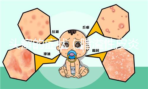 頭癬的癥狀（脂溢性皮炎和頭癬區別）