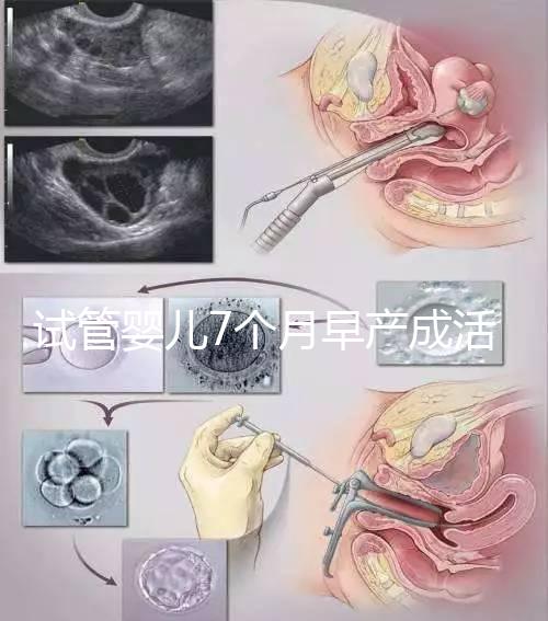 試管嬰兒7個月早產成活率高達80%！能不能要看身體狀況