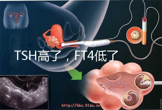 TSH高了，FT4低了，需要補碘嗎？